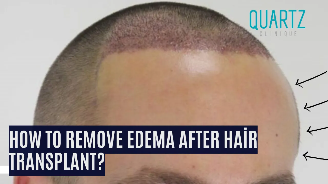 How To Remove Edema After Hair Transplant? - Quartz Hair