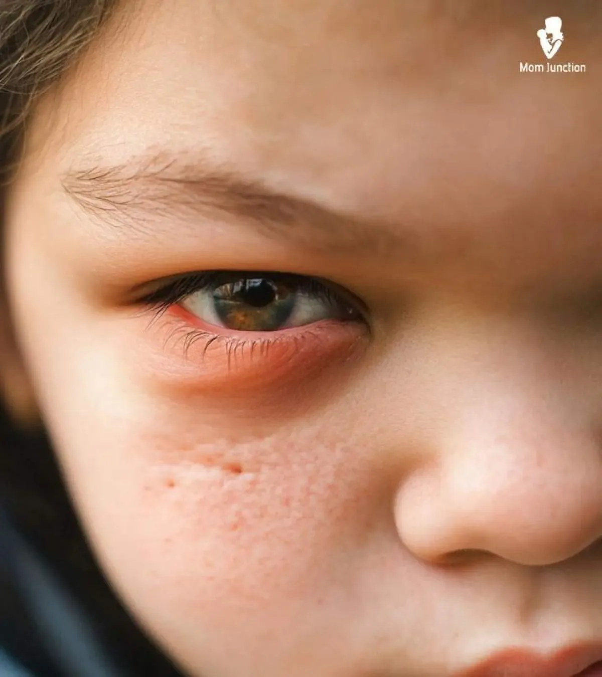Swollen Eyes In Children: Causes, Homecare Tips & Treatment