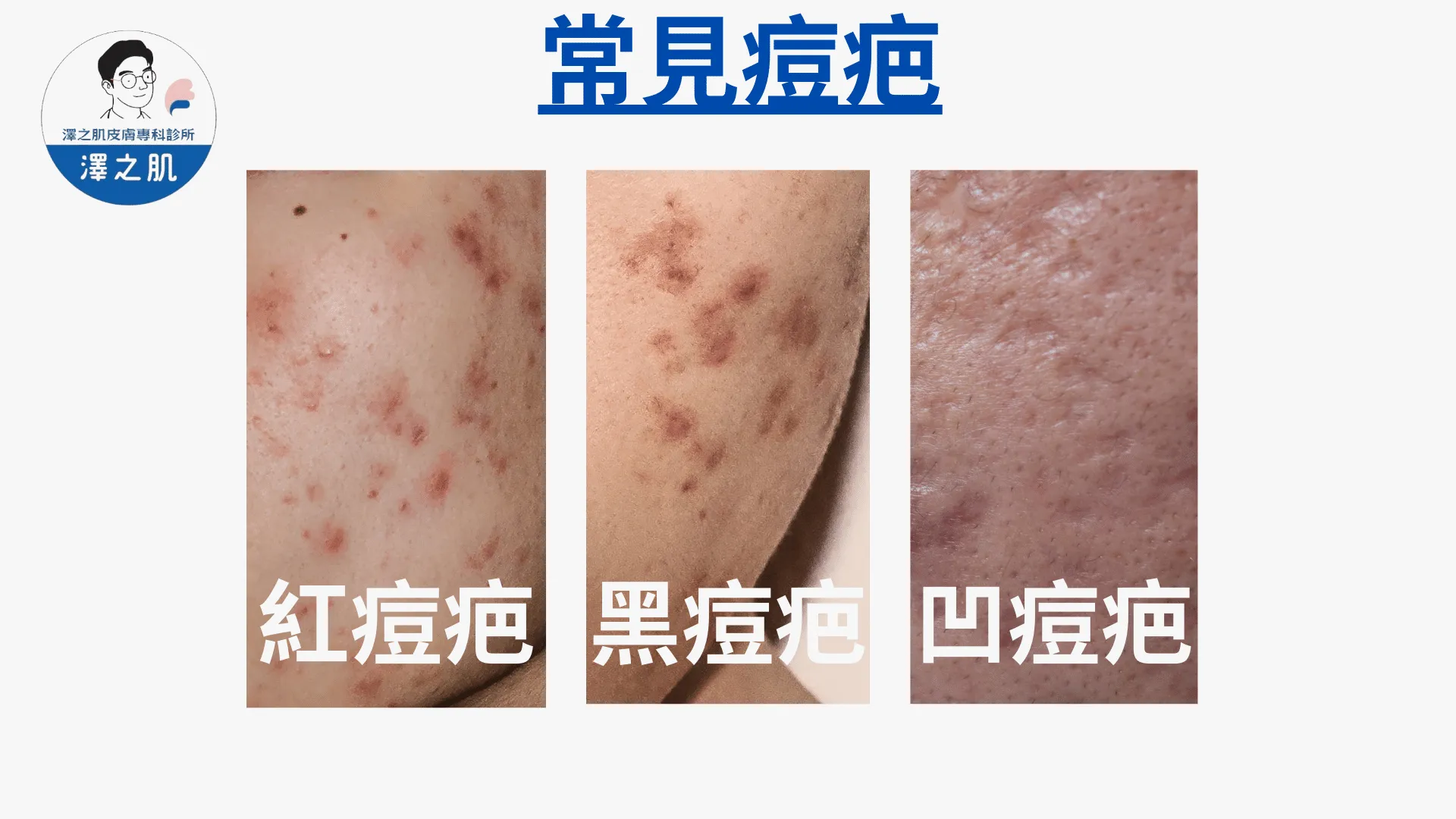 痘疤淡化的最佳護膚方案：凹陷型、色素型痘疤完整解決攻略