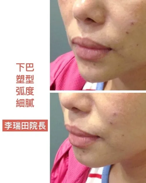 玻尿酸填充術後保養：防止腫脹與推移的小秘訣！高效消腫攻略，完整教學
