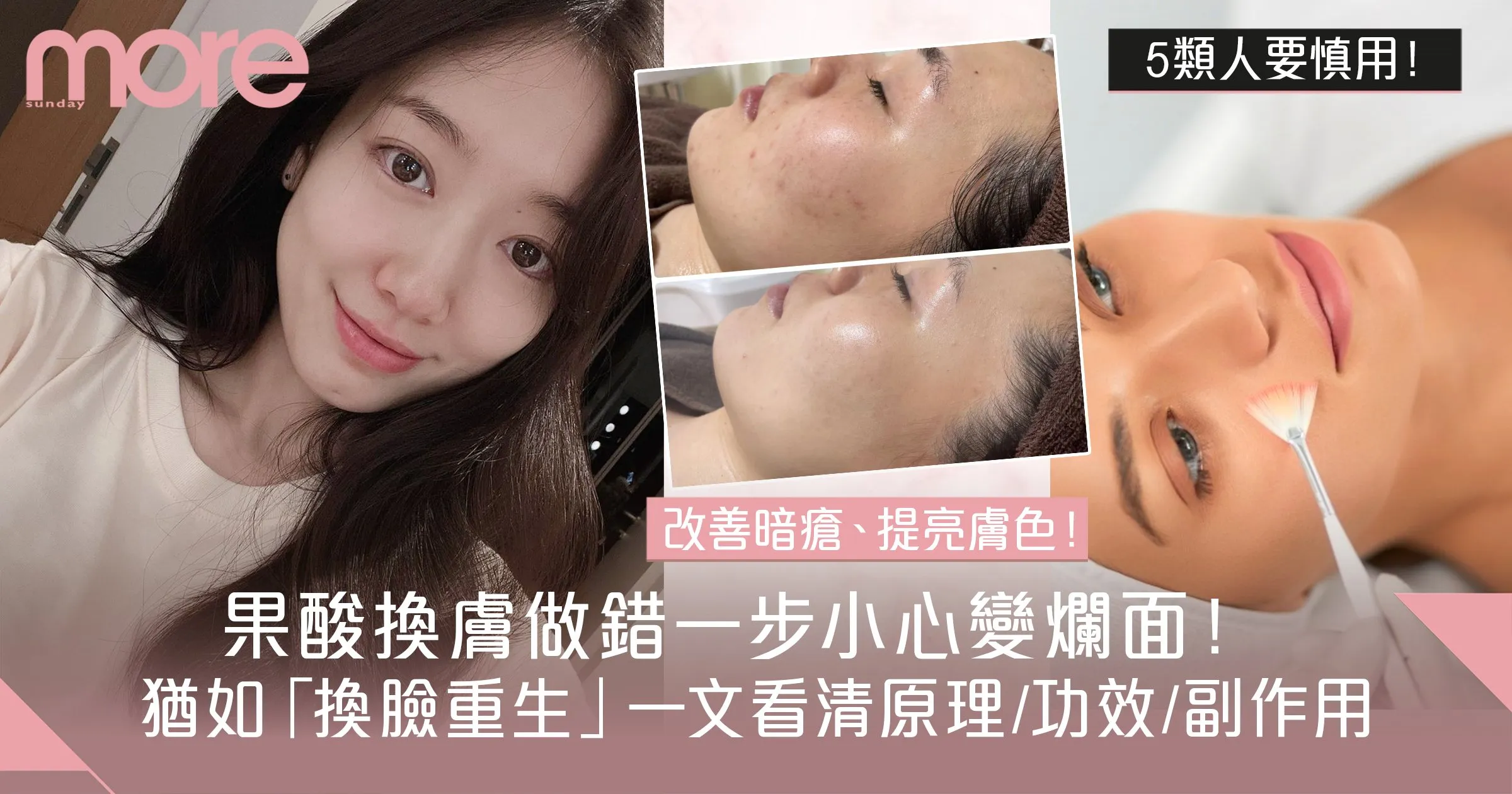 果酸換膚術後保濕：重建角質屏障的關鍵！高效保濕攻略，擺脫乾燥困擾