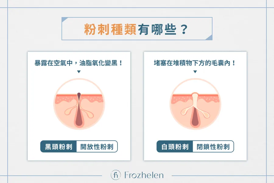 適合痘痘肌的最佳成分：高效解決粉刺的完整教學