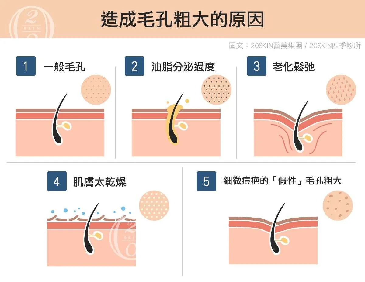 如何減少因油脂分泌引起的毛孔粗大？皮膚科醫生完整教學及高效秘訣