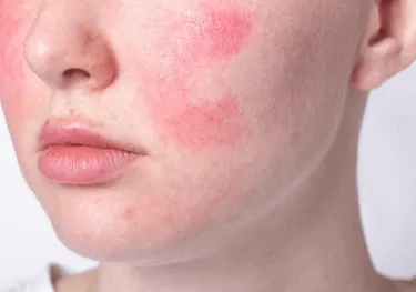 皮膚屏障受損擦什麼？高效修復指南：預防與改善肌膚乾燥、敏感問題