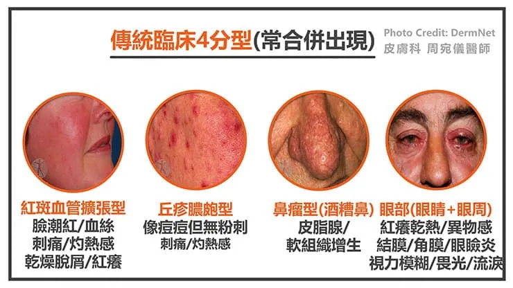 酒糟無法根治嗎？控制病情、揮別酒糟困擾的秘密