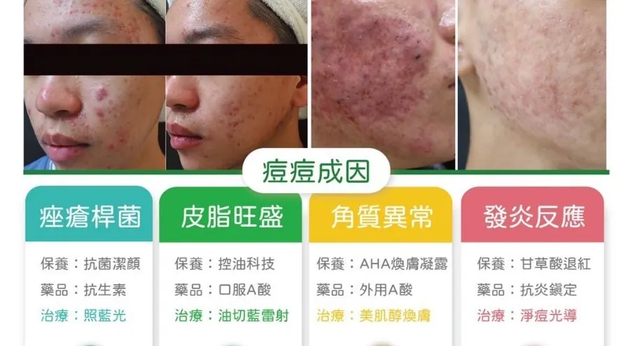 控油護膚技巧完整教學:告別油光痘痘,找回自信美肌