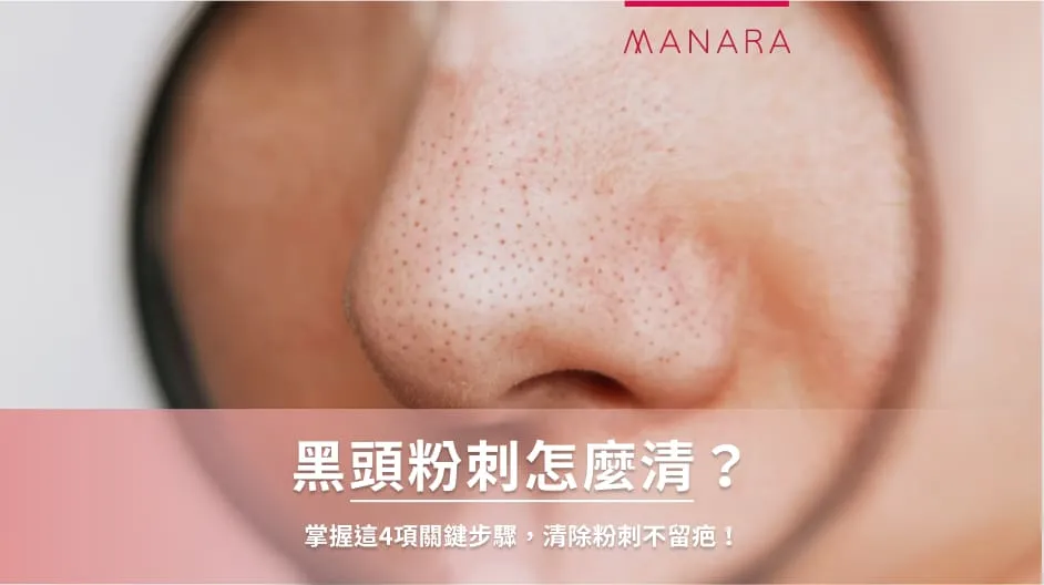 如何正確清除黑頭粉刺：避免擠壓，用去角質產品高效溶解油脂