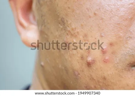 痘痘發炎紅腫怎麼辦？居家緊急處理與預防攻略：必學消炎止痛，擺脫痘疤！