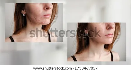囊腫痘痘藥膏怎麼選？專家教你挑對藥膏，擺脫囊腫困擾！