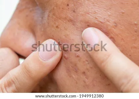 人中長痘痘可以擠嗎？保持良好衛生習慣，遠離人中痘痘困擾！