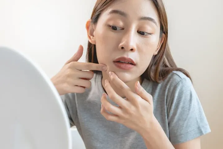 我的粉刺是「黑頭」還是「閉鎖性」?不同類型的粉刺,需要不同的處理策略