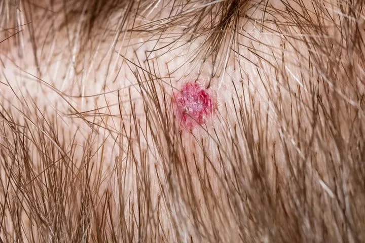 頭皮長痘痘