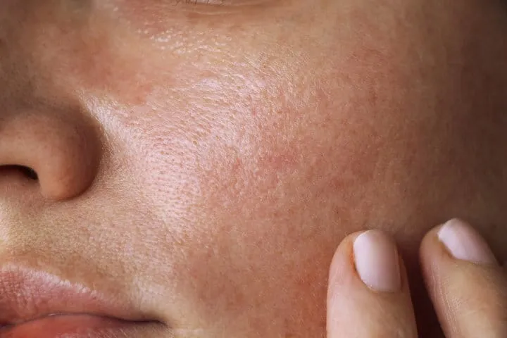 skin