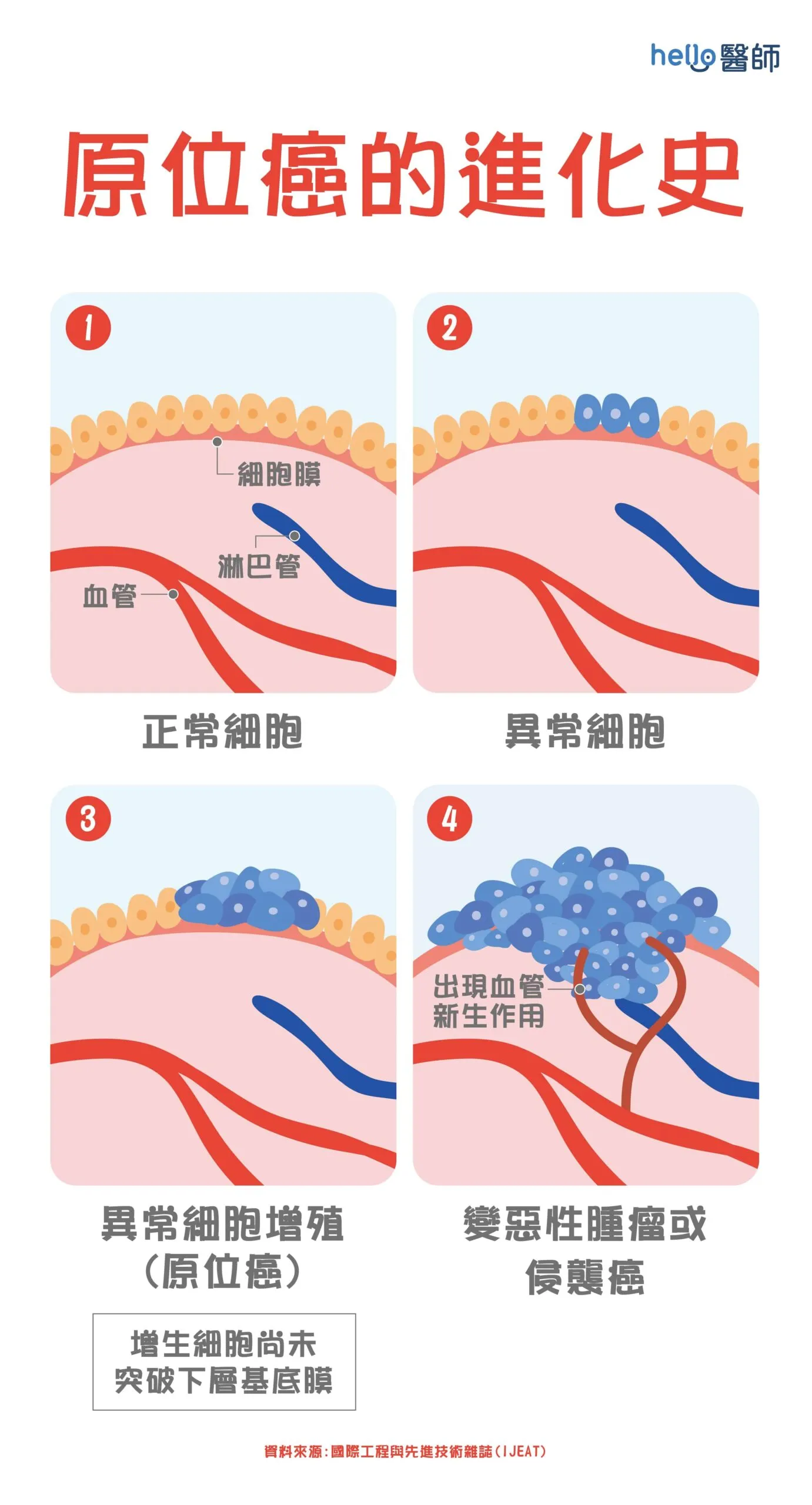 原位癌不算是重大疾病?醫師詳解原位癌的定義、治療與預後