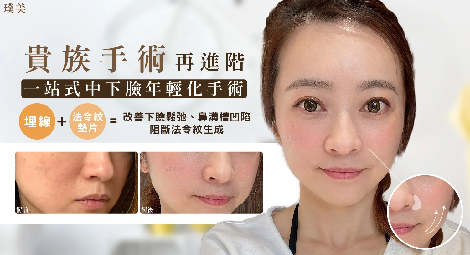 臉部撫紋手術後的修護黃金期:如何確保最佳成果,完整教學及術後照護攻略