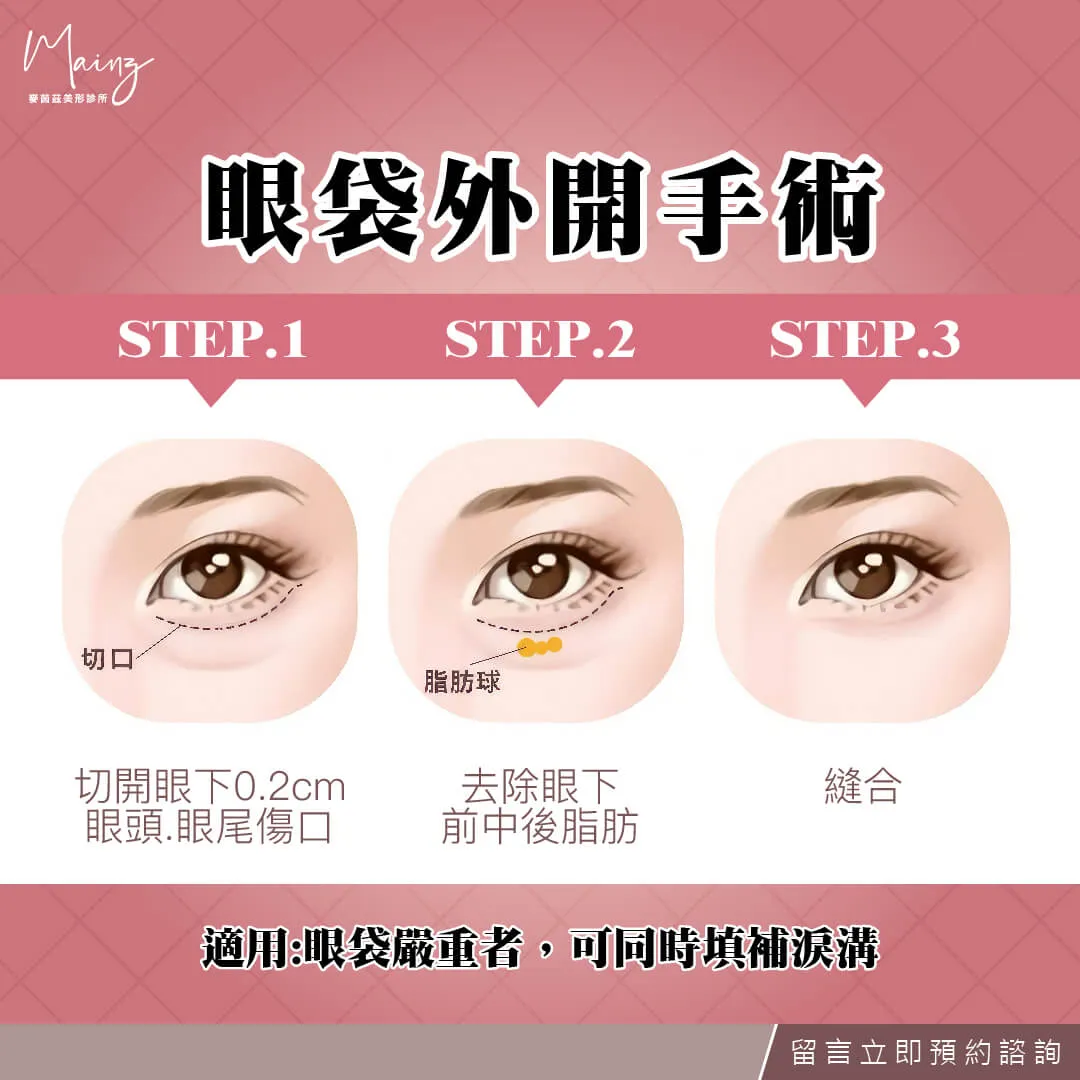 如何針對眼袋問題設計護理方案？皮膚科醫生教你高效解決眼袋困擾！