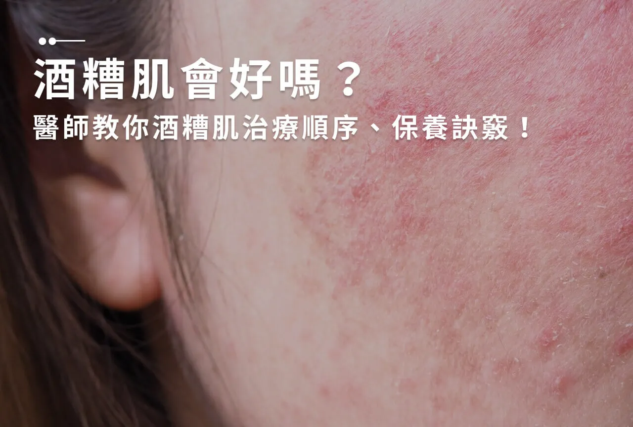 酒糟能不能根治?皮膚科醫師教你如何對抗酒糟