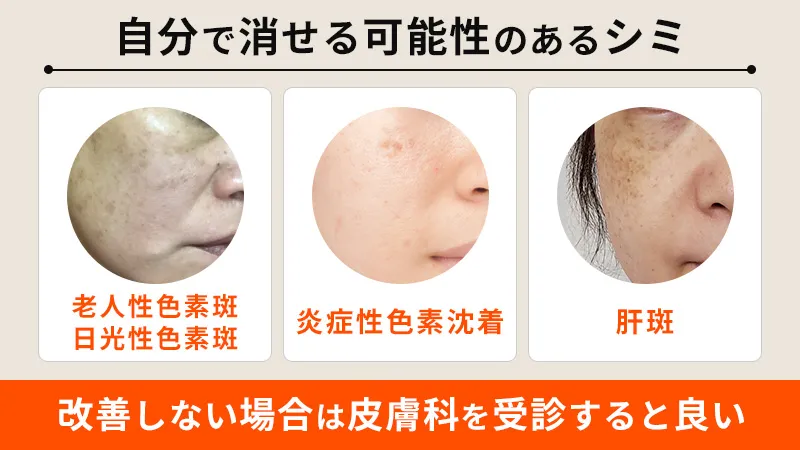 シミ対策の秘訣！スキンケア製品で色素沈着を軽減する方法