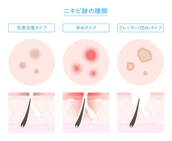 ニキビ跡を減らす！スキンケアの効率的攻略法