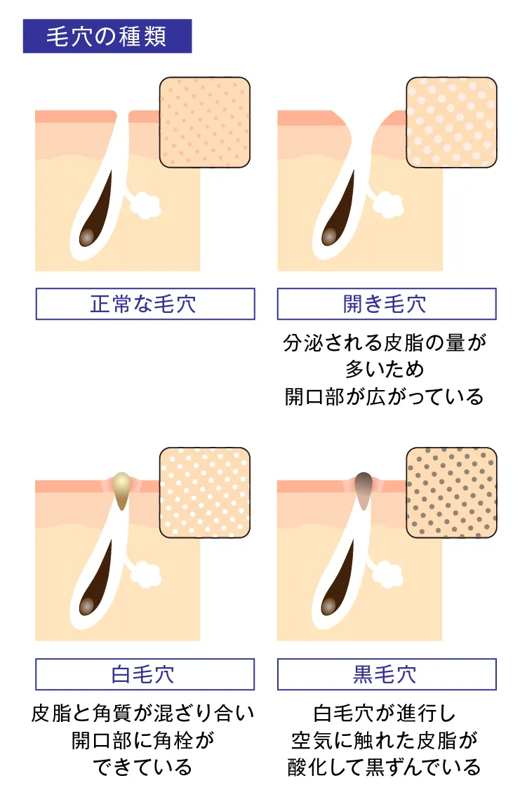 毛穴詰まりを防ぐスキンケア方法：医師が教える美肌への効率的攻略法