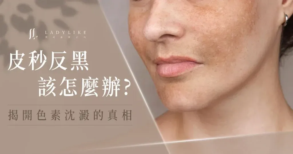 臉部醫美雷射術後如何避免反黑與色素沉澱?皮膚科醫師的完整教學與高效防護指南