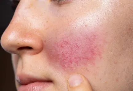 如何利用溫和護膚品改善泛紅現象?敏感肌泛紅急救指南!