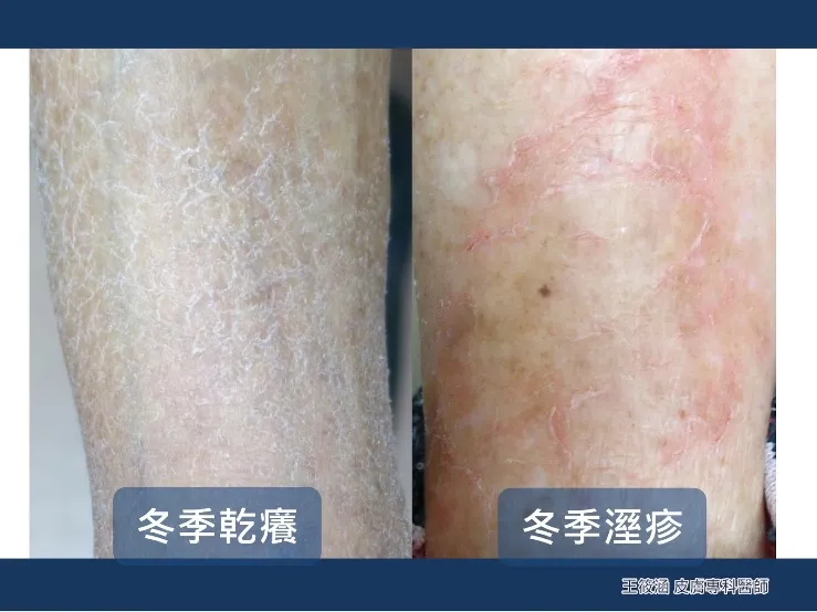 如何處理季節性皮膚乾燥?皮膚科醫生完整教學,告別冬季乾癢肌膚!