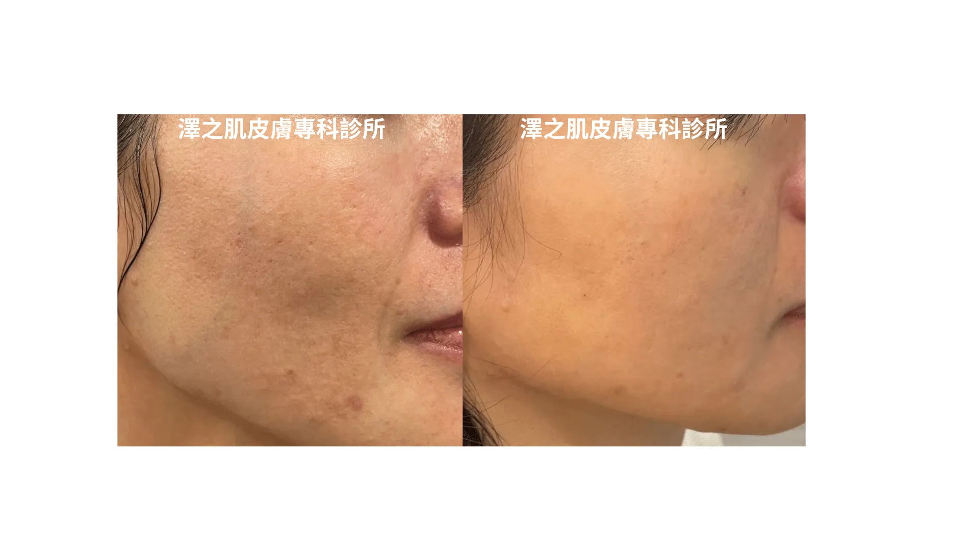如何改善肌膚粗糙的問題?皮膚科醫生完整教學,告別粗糙肌膚!