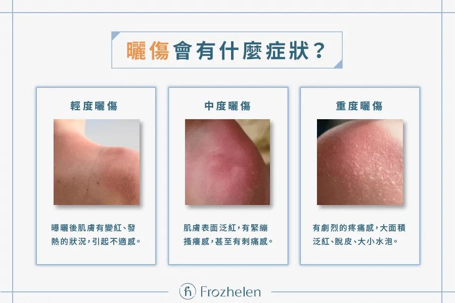 曬傷脫皮後會變白嗎?皮膚科醫師教你高效修復曬後肌膚